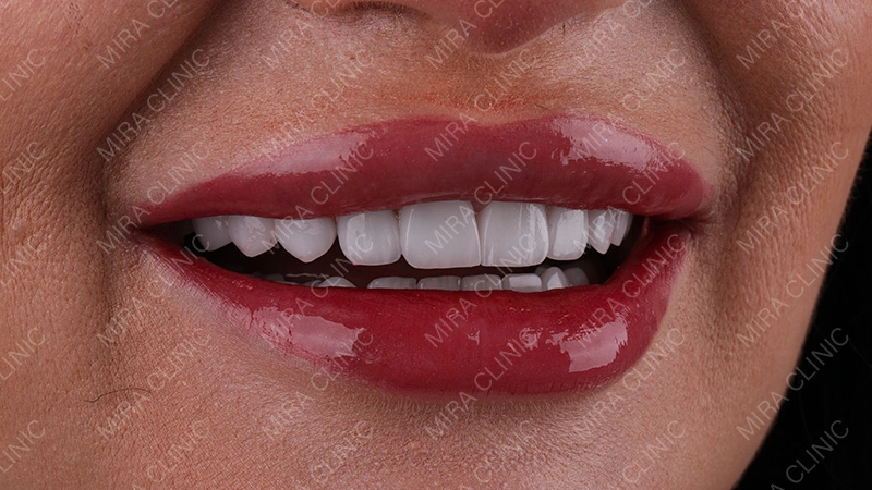 tooth visibility in motion 